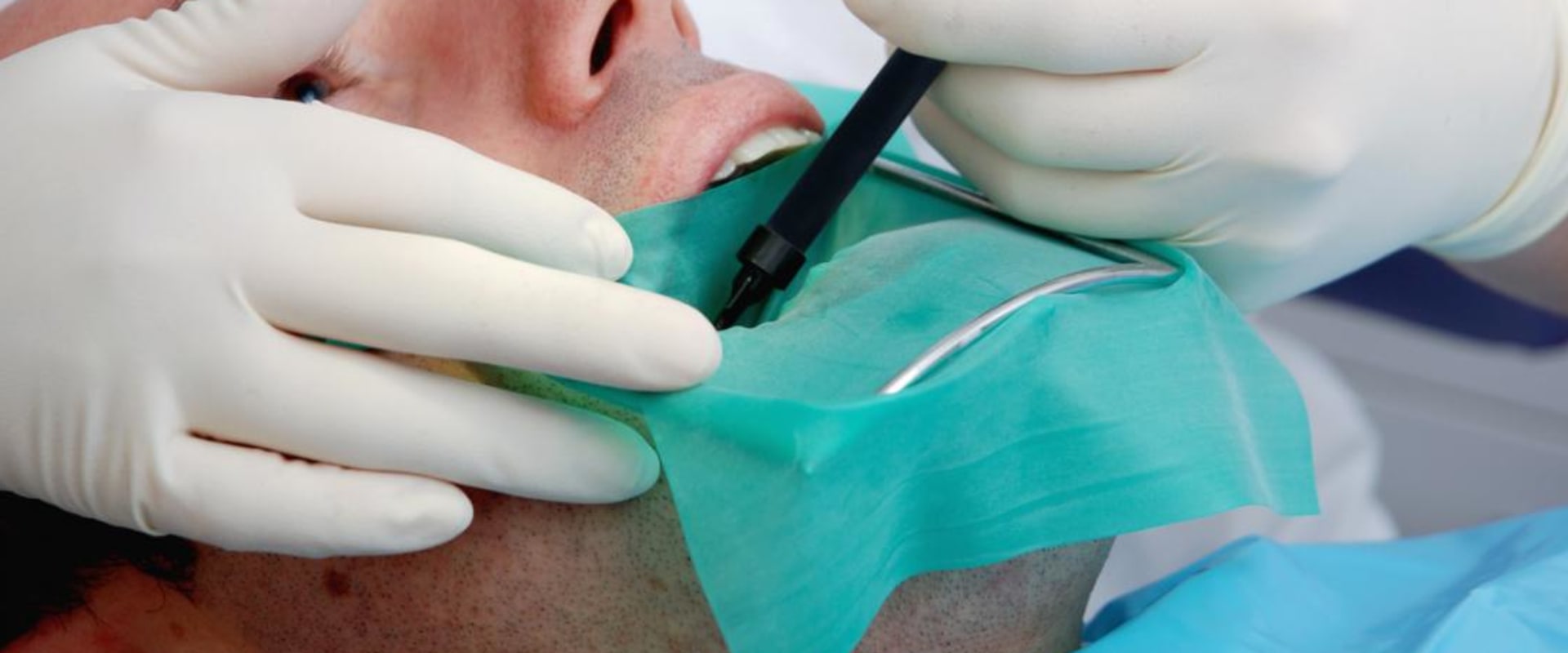 Explaining the Procedure: What You Need to Know About Root Canal Therapy